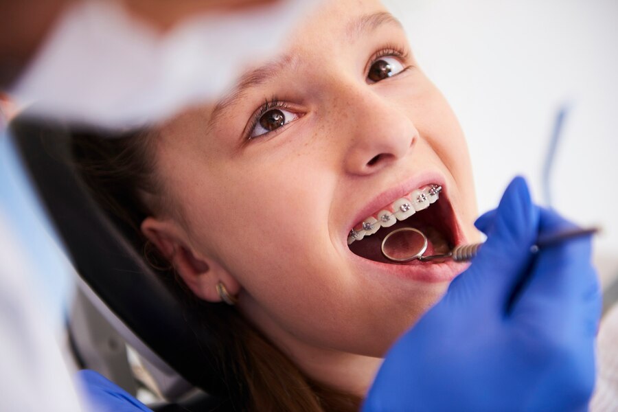Best Age for Braces: Ideal Timing for a Perfect Smile